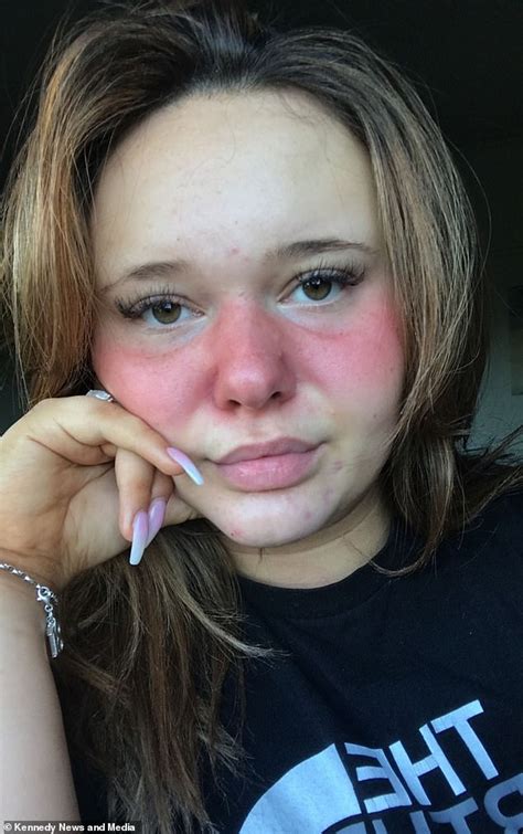 Lupus Suffering Teen Spends Up To 90 Minutes Covering Up