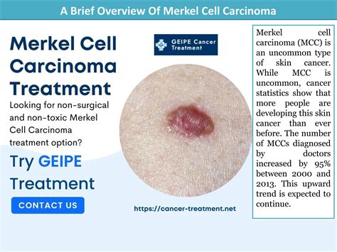 A Brief Overview Of Merkel Cell Carcinoma By Geipe Cancer Treatment Issuu