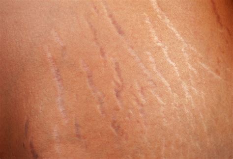 How Do Stretch Marks Happen Spa Md