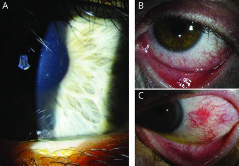 Findings Of Dupilumab Associated Ocular Surface Disease Illustrating