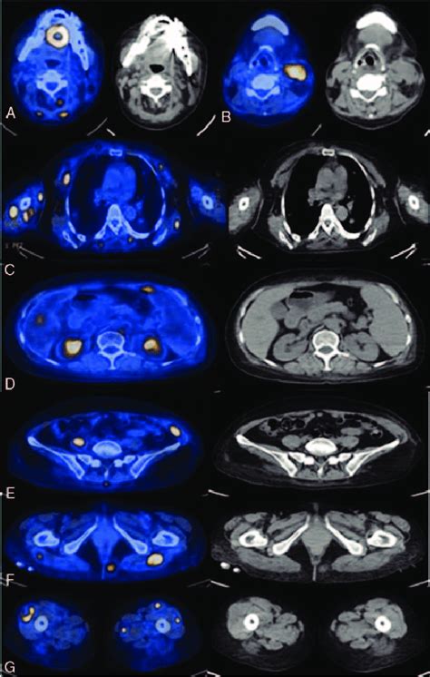 Selected Trans Axial Slices Of Fused Pet Ct And Attenuationcorrected
