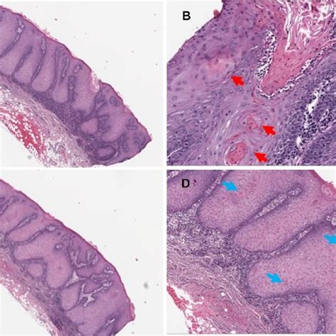 A Biopsy Of A Proliferative Verrucous Leukoplakia Pvl Lesion