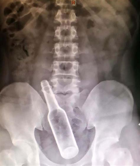 Chinese Man Undergoes Surgery To Remove Bottle From Rectum After Getting It Stuck While