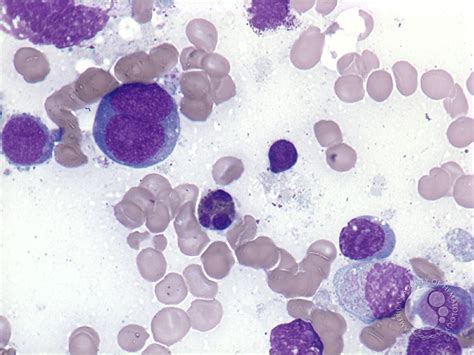 Mature t cell lymphoma that does not meet criteria for other t cell lymphomas in the current who classification system. Extranodal NK/T-cell lymphoma - 3.