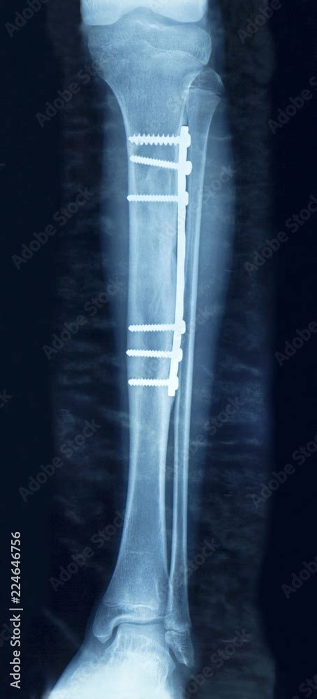 Film X Ray Show Fracture Shaft Of Tibia And Fibular Insert Plate And