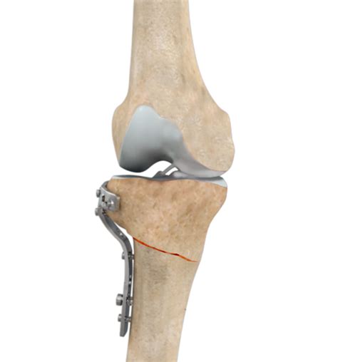High Tibial Osteotomy Dallas Tx Unicompartmental Osteoarthritis