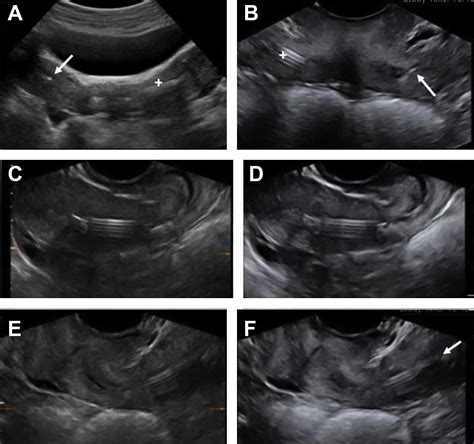 Ultrasound Assessment Of The Intrauterine Device Obstetrics And Gynecology Clinics