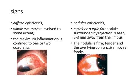 Diseases Of Sclera Ppt Ophthalmology
