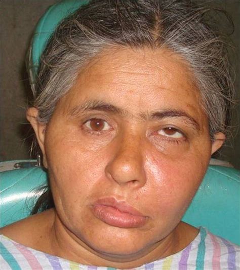 Preoperative Clinical Presentation Of Patient Showing Swelling On Left