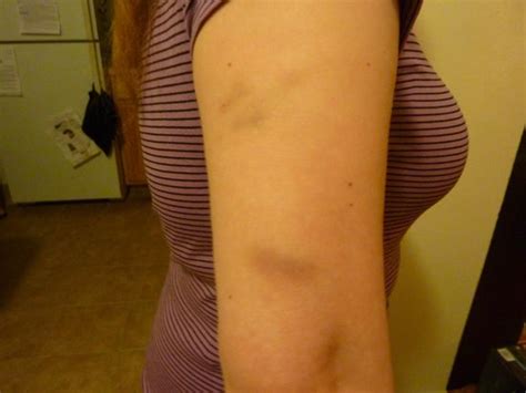Bruises Put On My Arm By The Bartender