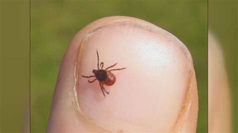 Rare Tick Borne Disease In Michigan