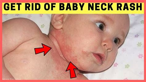 Simple Treatments For Baby Eczema Rashes Baby Neck Rash Baby Rash Hot