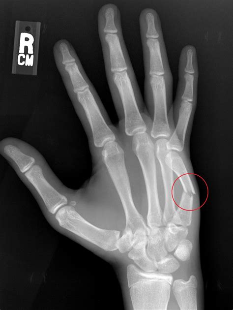 Metacarpal Fracture Treatment In Raleigh Durham Cary Nc Raleigh Hand