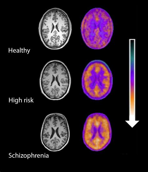 Study Finds Inflammation In The Brain Is Linked To Risk Of Schizophrenia