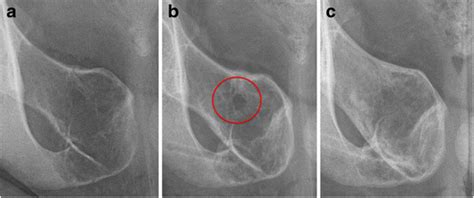 Treatment Of Aneurysmal Bone Cysts By Percutaneous Ct Guided Injection