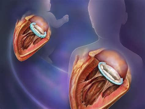 Heart Implant Can Grow With The Body Industry Tap
