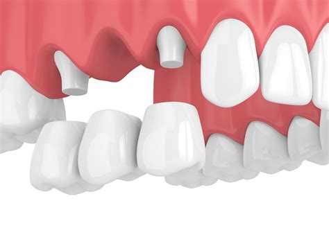 Choosing Dental Bridges For Missing Teeth Owings Mills Dentist