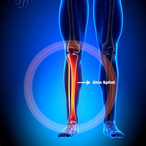 Shin Splints Causes Symptoms And Treatment Apex Performance Centre