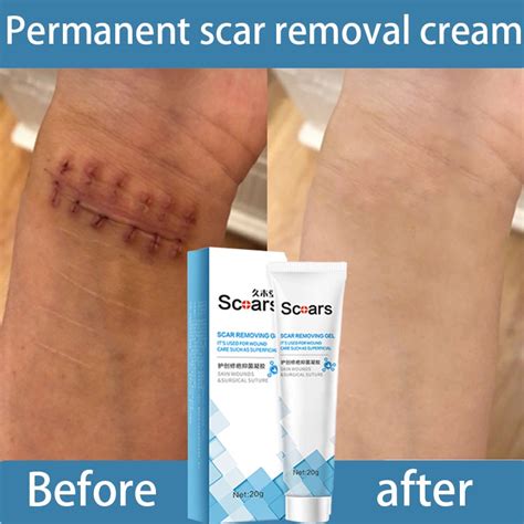 Scar Removal Cream Peklat Remover Acne Scars Treatment Stretch Mark
