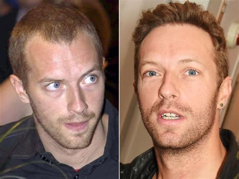 Celebrities Who Had Hair Transplant Surgery Flymedi