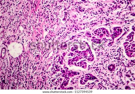 Lymph Node Metastasis Light Micrograph Cancer Stock Photo 1127394539