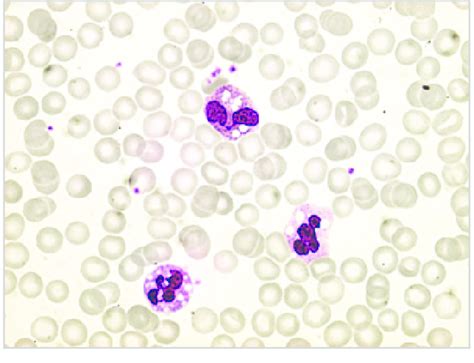 Prominent Intracytoplasmic Vacuoles Within Peripheral Blood