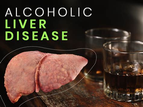Alcoholic Liver Disease Causes Stages Symptoms Risk Factors