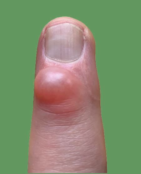 Mucous Cysts Aberdeen Virtual Hand Clinic