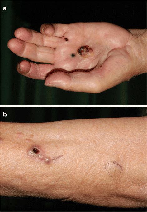 A 2 Cm Ulcerated Nodule On The Left Hand B Multiple Lesions On The