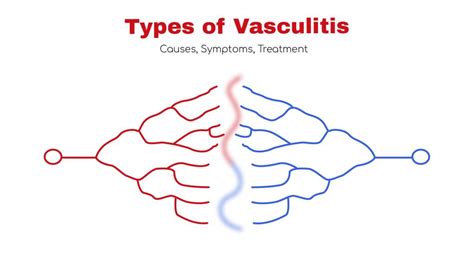 Types Of Vasculitis Symptoms Treatment Statcardiologist
