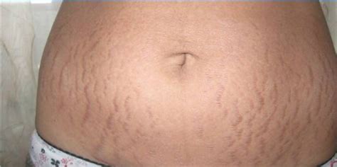 How To Remove Stretch Marks On The Stomach Effective Methods Of Getting Rid