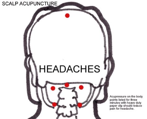 American Acupuncture Headache Treatment Points Are Shown