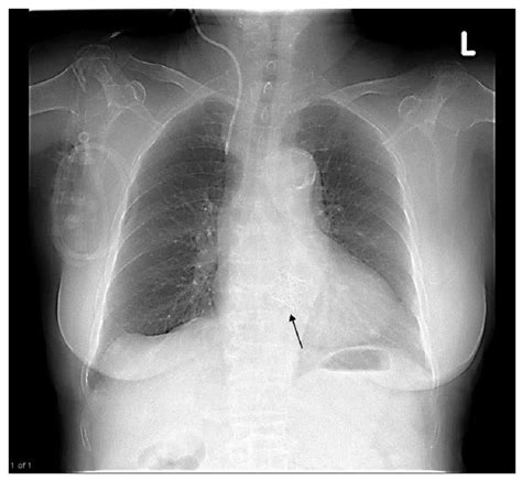 Chest X Ray After Transcatheter Aortic Valve Implantation Implantation