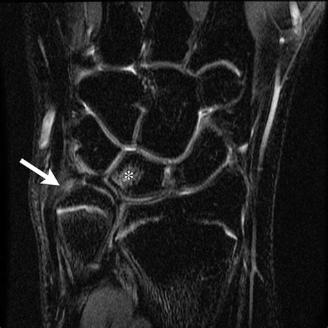 Pediatric Distal Forearm And Wrist Injury An Imaging Review