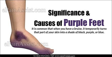 Significance And Causes Of Purple Feet