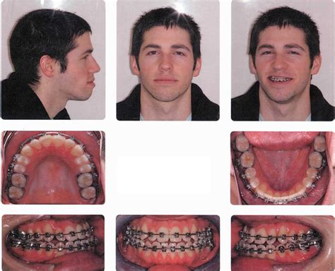 Introduction To Orthognathic Jaw Surgery Jaw Distract