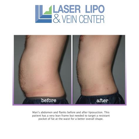 St Louis Liposuction Areas Liposuction Before After Liposuction