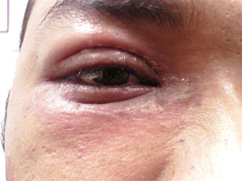 Periorbital Rove Beetle Dermatitis This Patient Had A Rove Flickr