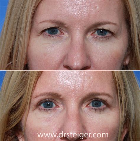 Blepharoplasty Eyelid Surgery Photos Before And After