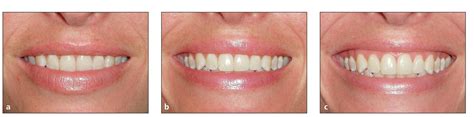 8 The Smile And Facial Harmony Pocket Dentistry