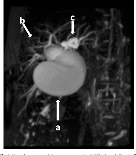 Figure 1 From The Use Of Laparoscopic Subtotal Cholecystectomy In A