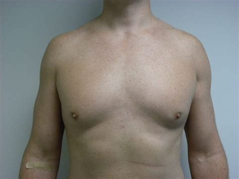 Gynecomastia Before And After Pictures Miami Aventura Fl