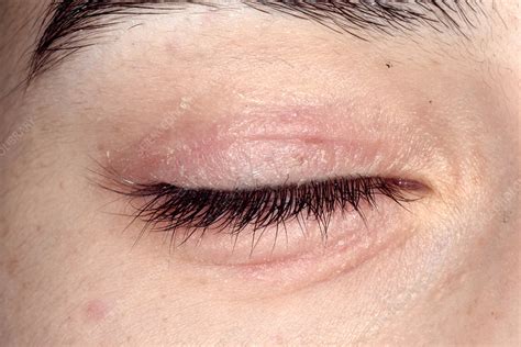 Eczema Around The Eye Stock Image C0284482 Science Photo Library