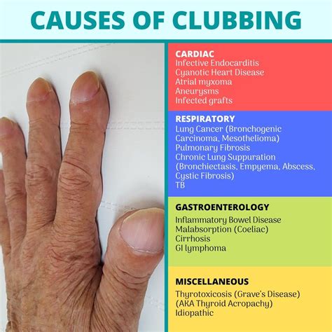 Top 100 Pictures What Does Clubbing Of The Fingers Look Like Updated