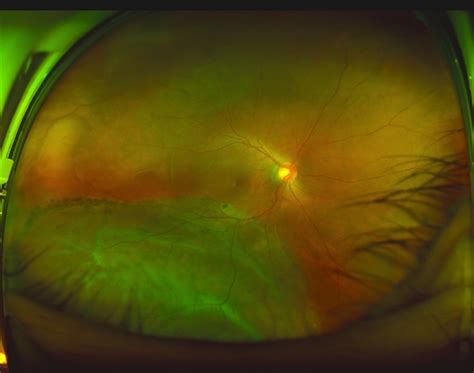 Chronic Retinal Detachment Retina Image Bank