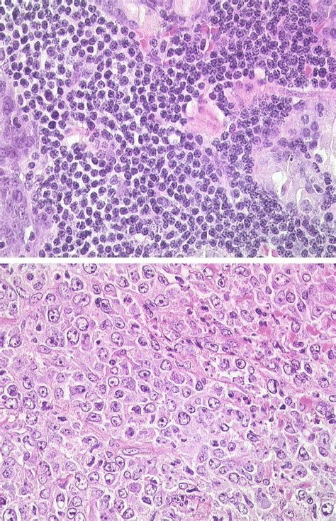 Histology Of A Typical Small Cell Gastric Marginal Zone B Cell Lymphoma
