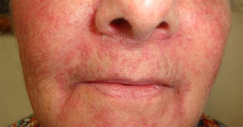 Consultations In Dermatology Rosacea Steroid Induced Video