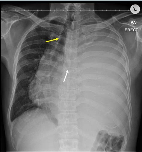 Opaque Hemithorax With Contralateral Mediastinal Shift Radiology Cases
