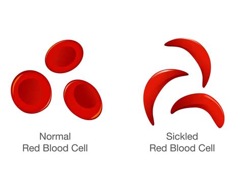 Sickle Cell Anemia What Happens When Red Blood Cells Are Sickle Shaped