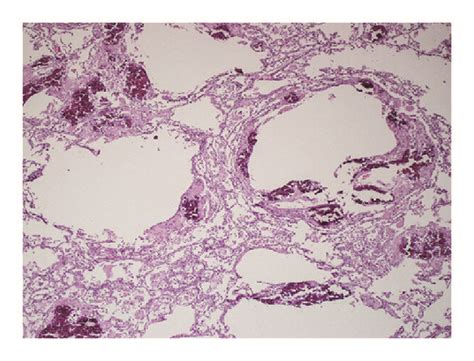 A Patient With Pneumocystis Jirovecii Pneumonia Low Power View Showing